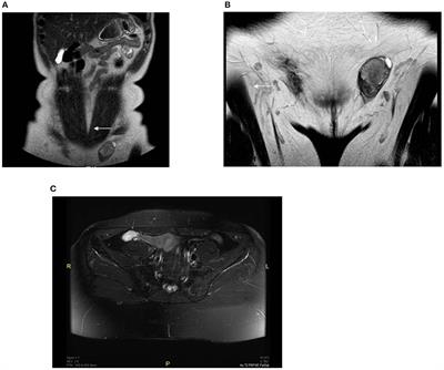 Novel Variant of the Androgen Receptor Gene in a Patient With Complete Androgen Insensitivity Syndrome and Polyorchidism